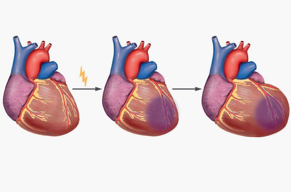 Myocardial infarction na-eduga na mgbu n'ubu ubu