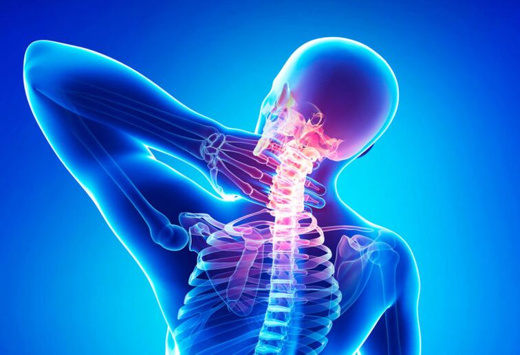 Osteochondrosis nke cervical spine