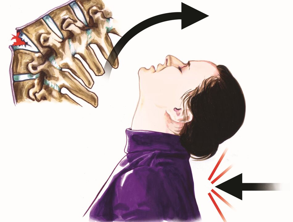 mmebi ọkpụkpụ azụ dị ka ihe na-akpata mgbu olu